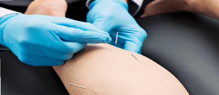 dry needling treatment centre in madurai